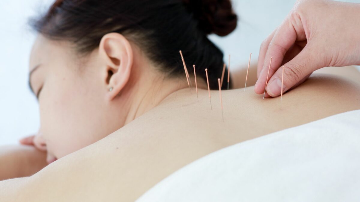 Acupuncture treatment at Surrey 152st Physiotherapy & Sports Injury Clinic