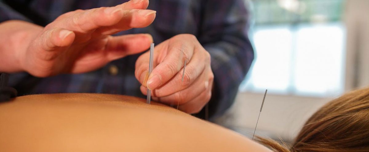Traditional Chinese Medicine Acupuncture | Surrey 152St Physiotherapy & Sports Injury Clinic